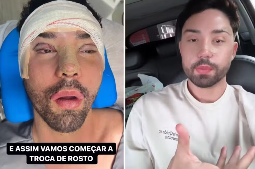 Rico Melquiades Recebe Alta Após Nova Cirurgia no Rosto: Uma Nova Transformação