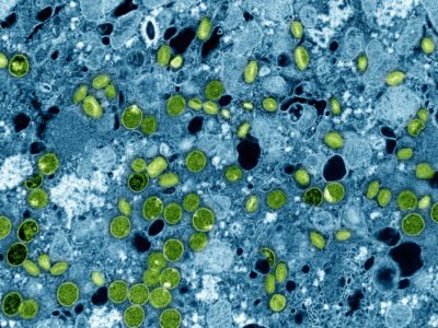 Mpox: sintomas, como pega e quem pode tomar a vacina no SUS